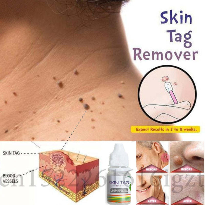 Skin Tag Remover – 12-Hour Fast Mole Removal Serum